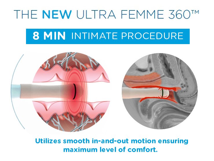 Exilis Ultra®Femme 360 Vaginal Rejuvenation- Package of 3 Treatments